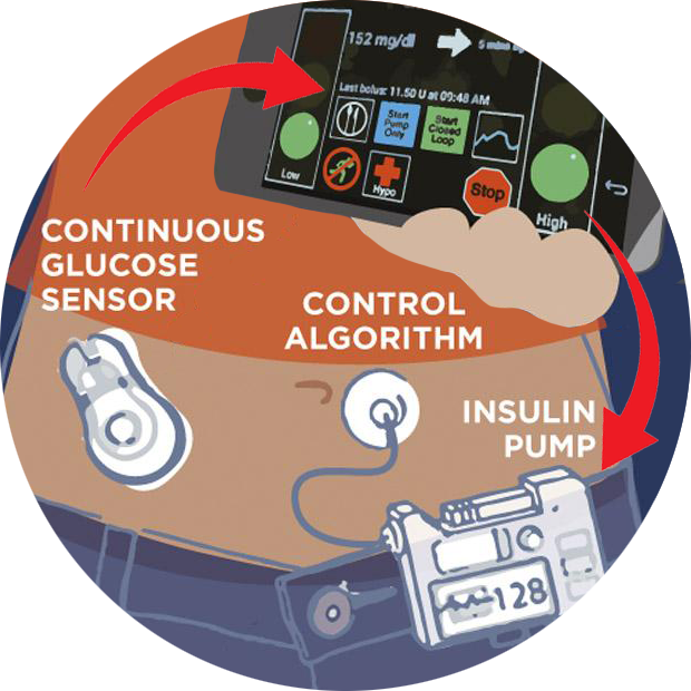A diagram showing a pump, a phone and a CGM
