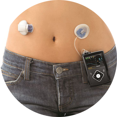 A person wearing a pump and a CGM