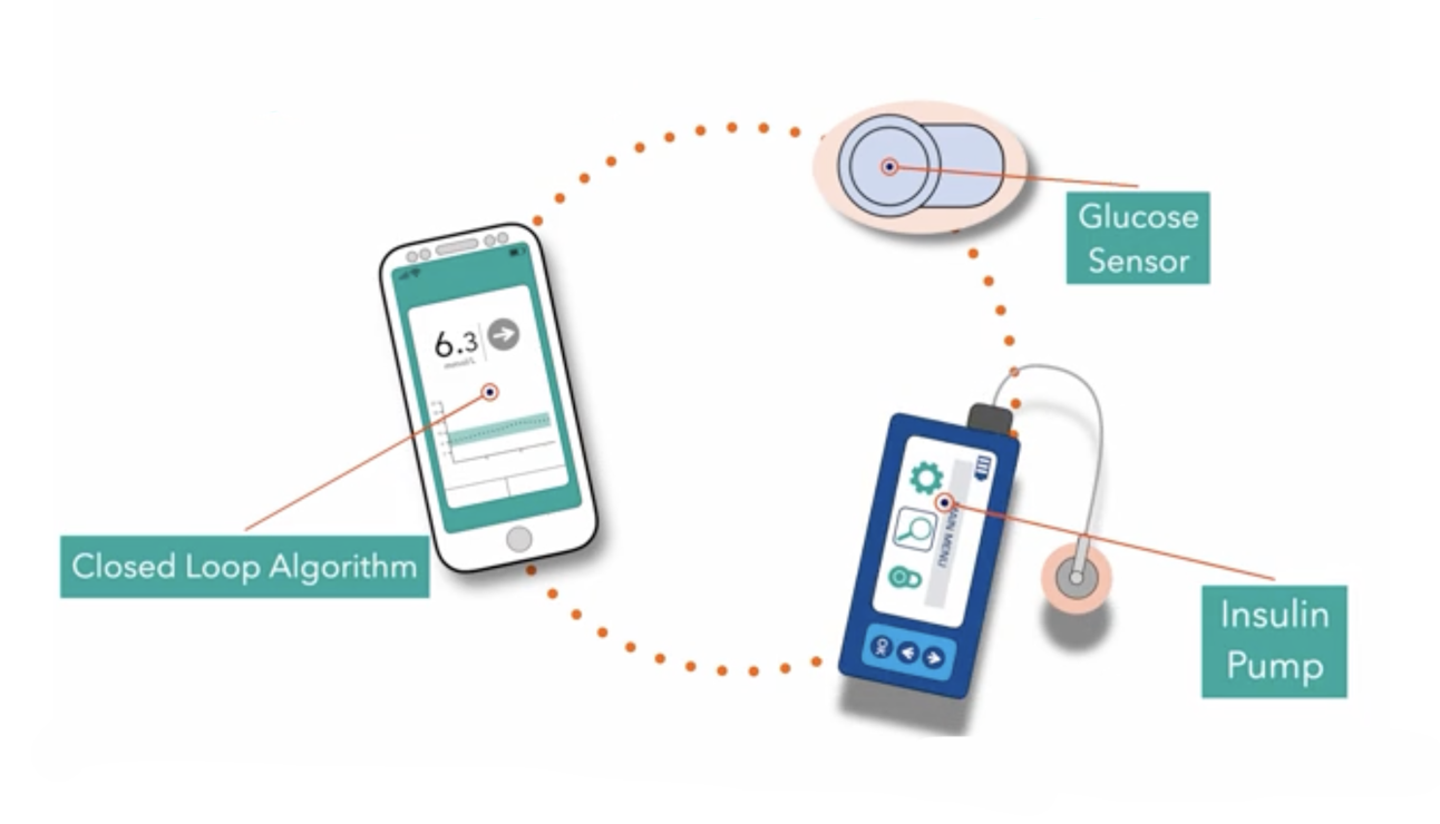 a phone that has an algorithm, a continuous glucose monitor and a pump.