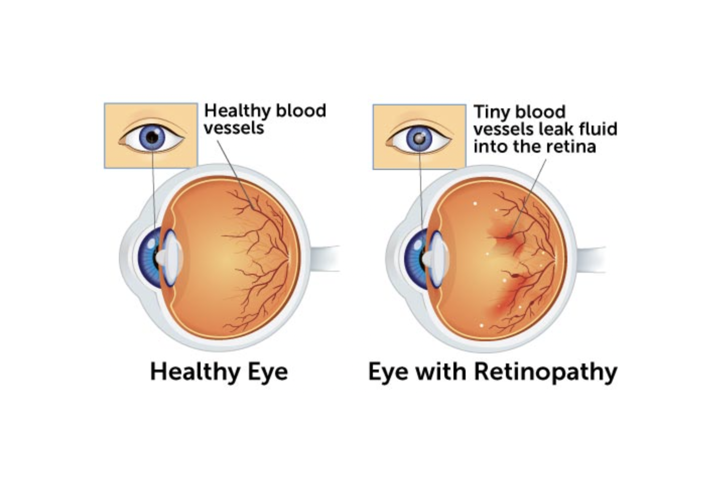 visual to complement text. Shows tiny blood vesels in the eye leaking fluid into the retina.