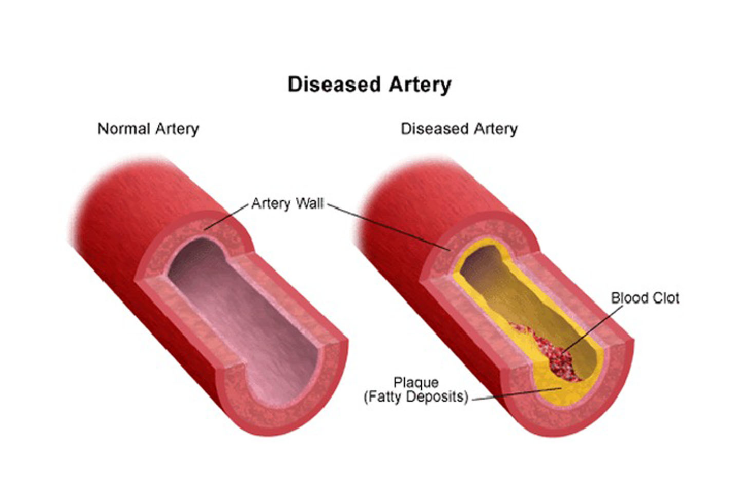 an image showing a heathy artery and a diseased artery. The diseased one has a yellow lining inside the artery wall made of fatty deposits and a blood clot.